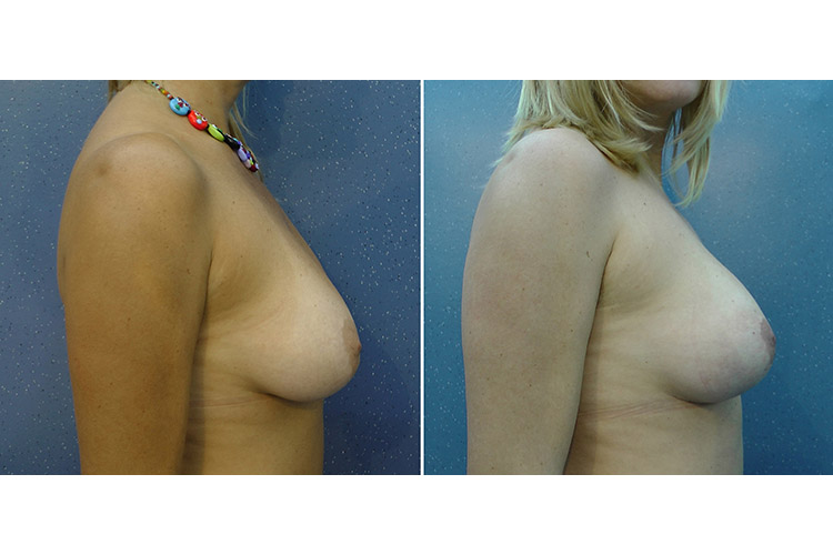 Breasts with implants: conization with a 1 cm incision at the areolar margin and the elastic thread